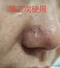 IMCAY水杨酸棉片湿敷改善痘痘印痘肌刷闭口粉刺去黑头收缩毛孔清洁3盒 实拍图