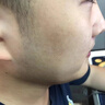 OHBT壬二酸15%凝胶水杨酸祛痘药膏祛痘淡化痘印坑消炎痤疮专用青少年 实拍图