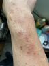 久卜制药湿疹药膏止痒抑菌皮肤瘙痒去根顽固湿毒皮炎汗疱真菌感染阴囊潮湿 实拍图