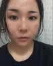 ASTACURE点痣点斑专用药脸部不留疤祛痣膏药水医用美容院专用官方正品去痣 实拍图