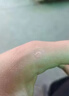 维A酸乳膏去疣体特新效期药扁平疣专用药去疣类药膏去脖子小肉粒颈部瘊子去尤瘊小肉粒去疣膏瘊子肉刺肉粒 1盒装【国药准字脱疣瘊】 瘊子去除国药准字药膏  放心购买 安心售后 实拍图