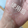 芭克官方kelocote美国疤克巴克祛疤膏15g硅凝胶淡化修复去疤痕 实拍图