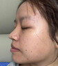 维A酸乳膏去疣体特新效期药扁平疣专用药去疣类药膏去脖子小肉粒颈部瘊子去尤瘊小肉粒去疣膏瘊子肉刺肉粒 1盒装【国药准字脱疣瘊】 瘊子去除国药准字药膏  放心购买 安心售后 实拍图