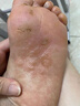 久卜制药脚气喷雾剂药止痒脱皮烂脚丫真菌感染狼毒王软膏脚臭痒克星治 3盒 实拍图