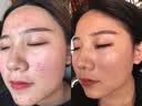 广德堂草本祛痘膏芦荟祛痘印淡化痘印痘坑男生女痘消闭口炎粉刺黑头 广德堂金芦荟祛痘膏20g+金芦荟控油净颜洁面乳50g 实拍图