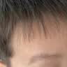 华美科医用重组人体表皮生长因子点痣疤痕修复凝胶烫软膏伤口愈合15g1支 实拍图