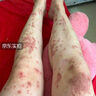 ELSIEDOCTOR湿疹药膏止痒去根皮肤瘙痒皮炎湿疹真菌感染汗疱疹肛门瘙痒 实拍图