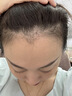 【第二代米诺地尔】蔓迪生发泡沫60g*2（敏皮专属 温和不油腻）5%男女士快速防脱育发米洛原液搽剂酊曼迪 实拍图