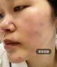 井次制药去痣点痣膏水脸部痦子扁平疣瘊子面部黑痣男女士通用试用装 实拍图