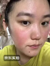 YYTISS医用面膜械字号冷敷贴医美激光术后修复保湿补水玻尿酸透明质酸钠 实拍图
