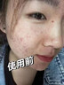BEAUTY NOTES积雪草苷霜复颜祛痘膏正品24%舒缓修复祛痘印痘坑黑色素面霜男女 实拍图