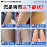 Qorminiy去鸡皮肤疙瘩毛囊角化症专用的药去除大腿胳膊手臂粗糙腿神器儿童 【中度鸡皮/闭口疙瘩】2瓶周期装/96%用户选择 一抹去鸡皮 实拍图