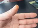 [扬子洲]硝酸咪康唑乳膏 2%*20g 1盒装 手癣真菌感染药手裂口干裂膏皲裂膏手足皮肤干燥开裂膏手开裂用药手指裂口愈 手癣手裂口用药 实拍图