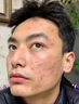 乔记去痘痘和痘印修复凹洞男淡化痘坑消填充再生凝胶生长收缩毛孔医用 膏体*5【想抹平痘坑痘印】多数人选择 祛痘印痘坑修复男生痘印痘坑痘疤修复淡化消除黑色素 实拍图
