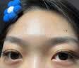 [花容美]阿达帕林凝胶 祛痘药膏祛痘印修复淡化痘印医用祛痘消炎痤疮专用青少年祛痘消炎痤疮专用皮肤用药 0.1%*10g 1盒装 【脸上起粉刺】 实拍图