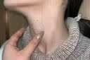 [臣功]维A酸乳膏 15克/支 1盒装 刺猴去好根瘊疣膏猴子去除药膏猴子扁平疣去除药膏刺猴专用的药特寻常疣鱼鳞痣小肉粒效 肉粒刺猴疙瘩在萌芽期使用 实拍图