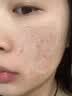 [花容美]阿达帕林凝胶 祛痘药膏祛痘印修复淡化痘印医用祛痘消炎痤疮专用青少年祛痘消炎痤疮专用皮肤用药 0.1%*10g 1盒装 【脸上起粉刺】 实拍图