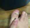 久卜制药灰指甲专用指甲增厚发黄变厚真菌感染有效重度可搭甲贴抑菌膏1盒 实拍图