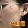 维特丝痘痘贴帖消炎吸脓修复痘印医研舒缓祛痘星星款隐形痤疮专用青少年 实拍图