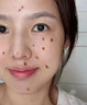 藤石制药激光点痣后脸部去红印黑印凹陷修复凝胶祛痣疤痕膏淡化红印色素DS 两盒装第二盒半价 实拍图
