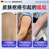 Qorminiy去鸡皮肤疙瘩毛囊角化症专用的药去除大腿胳膊手臂粗糙腿神器儿童 【中度鸡皮/闭口疙瘩】2瓶周期装/96%用户选择 一抹去鸡皮 实拍图