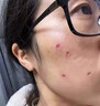 BKWILD医用重组生长因子凝胶胶原蛋白点痣喷人表祛疤痕膏修复生肌膏 实拍图