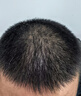 蔓迪【二代米诺地尔】蔓迪5%生发泡沫60g*2（敏皮专属 温和不油腻）男女士快速防脱育发米洛原液搽剂酊曼迪 实拍图