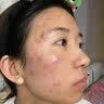 透真水杨酸果酸精华液收缩毛孔粗大修复控油祛痘淡化痘印痘坑壬二酸 实拍图