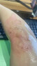 修正疤痕灵医用硅酮疤痕增生凸起修复凝胶软膏烧伤烫伤伤疤膏 1支（20g/支）【体验装】 实拍图