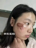 YYTISS美国祛疤膏除疤去剖腹产疤痕药膏手术缝针修复凝胶医院专用硅酮 实拍图