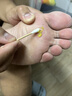 高坂制药鸡眼贴膏去肉刺刺猴药膏无痛脱落连根拔除跖疣专用去脚底老茧20g 实拍图