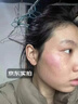 YYTISS美国祛疤膏除疤去剖腹产疤痕药膏手术缝针修复凝胶医院专用硅酮 实拍图
