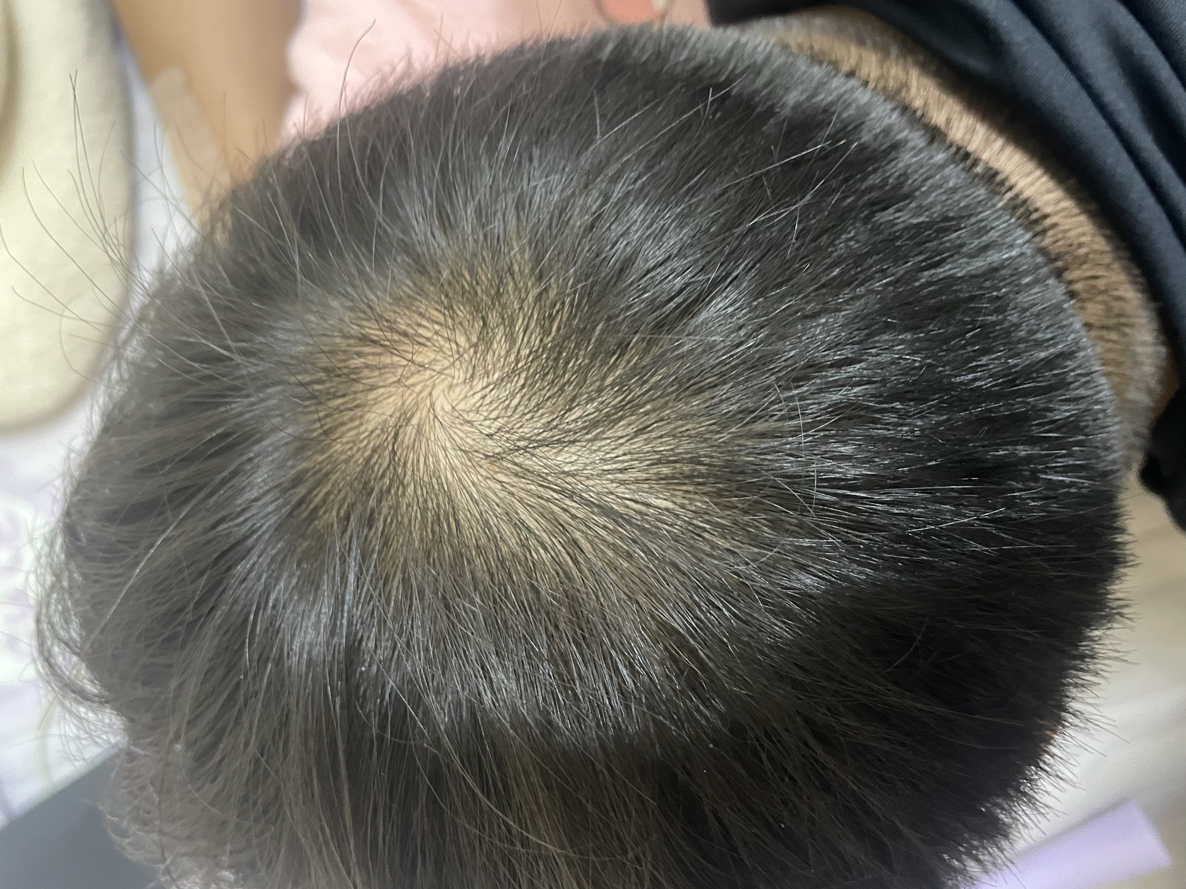 蔓迪生发喷雾5%米诺地尔酊90ml*2瓶男士专用治脱发育发斑秃原液搽剂曼迪京东自营米洛地尔生发剂 实拍图