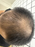 蔓迪【二代米诺地尔】蔓迪5%生发泡沫剂60g(倍速温和) 男士专用治脱发防脱洗发水育发米洛原液酊搽剂 实拍图
