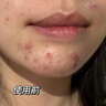 维特丝痘痘贴帖消炎吸脓修复痘印医研舒缓祛痘星星款隐形痤疮专用青少年 实拍图