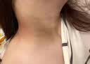 百约王黑棘皮病治脖子黑色素药膏胖人儿童去除腋下沉淀颈部肘关节症专用 单盒装【香港老品牌】50g 实拍图