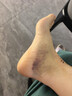麦德威（medwe）医用膝关节固定支具碳纤维膝盖支架腿部骨折韧带术后护具MD177-14 实拍图