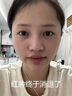 DR.MICKEY医用重组生长因子凝胶牛碱性成纤维细胞点痣喷人表皮祛疤痕膏修复 实拍图
