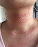 本安制药（BENAN PHARMACEUTICAL）荨麻疹专用膏皮肤瘙痒过敏止痒增强免疫力抑菌皮炎湿疹真菌1盒 实拍图