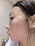 芙清壬二酸清痘精华乳15g祛痘改善黑白头粉刺毛孔修护 实拍图