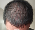 蔓迪【第二代米诺地尔】蔓迪5%米诺地尔泡沫剂60g/3瓶/盒生发液防脱洗发水用于治疗脱发和斑秃 实拍图