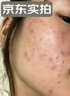 KEORKAO祛痘药膏去痘痘淡化痘印消炎痤疮专用祛痘精华青少年青春痘试用装 实拍图