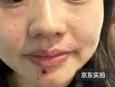 井次制药去痣点痣膏水脸部痦子扁平疣瘊子面部黑痣男女士通用试用装 实拍图