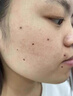高坂制药点痣膏点斑祛疣药水脸部去黑痣扁平跖疣修复液无痕不留疤非药5ml 实拍图
