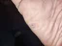 李时珍鸡尤康贴鸡眼贴水杨酸手部脚步足部去肉刺刺猴脱落茧肉刺跎疣贴膏 两盒【24贴三个鸡眼患者】 实拍图