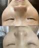高坂制药点痣膏点斑祛疣药水脸部去黑痣扁平跖疣修复液无痕不留疤非药5ml 实拍图