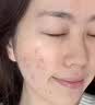 HEBST壬二酸凝胶15%浓度祛痘乳膏淡化祛痘印痘坑修复男士医美用60ml 实拍图