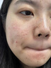 透真修复冻干粉精华液蓝铜胜肽多肽术后修护红血丝角质屏障敏肌泛红 实拍图