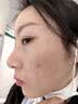 芙清壬二酸清痘精华乳15g祛痘改善黑白头粉刺毛孔修护 实拍图