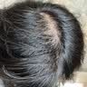 蔓迪【二代米诺地尔】蔓迪5%生发泡沫剂60g*3（倍速温和生发）男女专用治脱发防脱洗发水育发米洛酊搽剂 实拍图